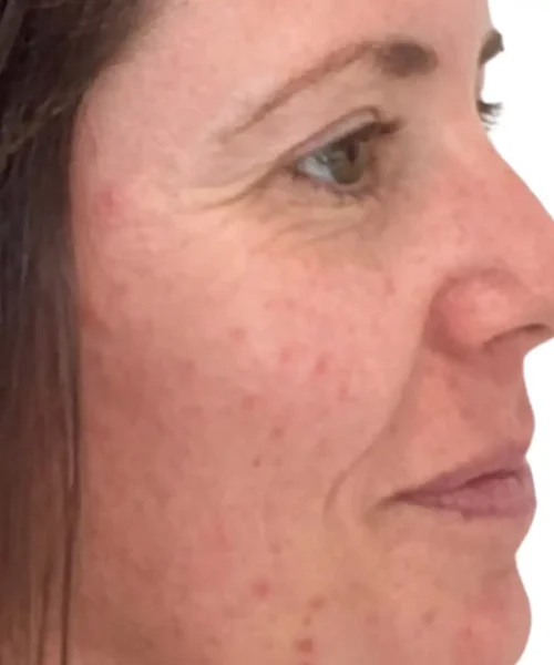 Before and After Treatment Image of Lady at Eluxir MD in Chesapeake, VA