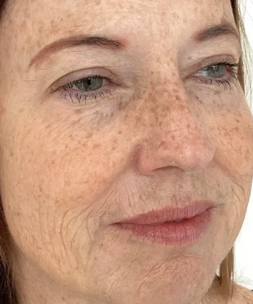 Before Treatment Gallery Image at Eluxir MD in Chesapeake, VA