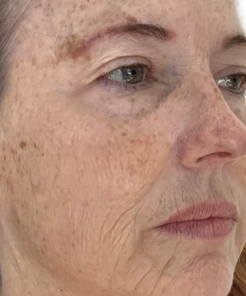 First Before and after Treatment Image of a Mid aged Women at Eluxir MD in Chesapeake, VA