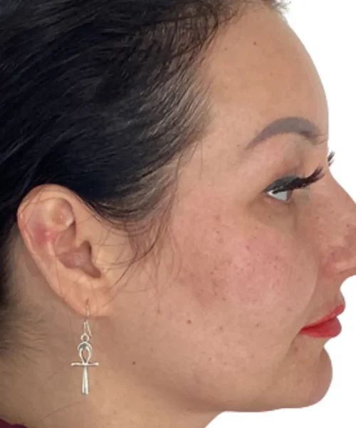 Second Before and after Treatment Image of a Women at Eluxir MD in Chesapeake, VA