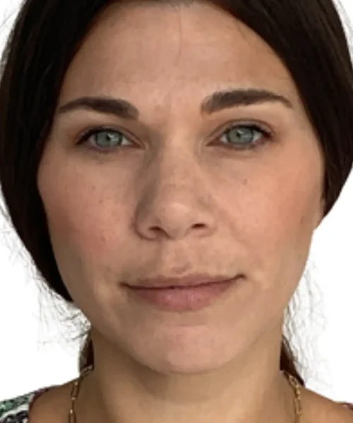 Before and after photo from Eluxir MD in Chesapeake, VA, showcasing improved skin tone