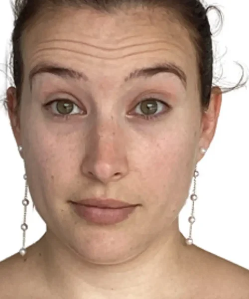 Before and after photo from EluxirMD in Chesapeake, VA, displaying enhanced skin smoothness