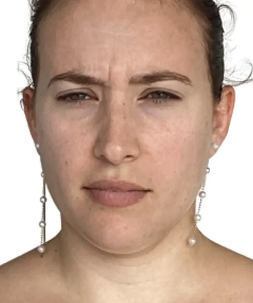 Before and after image from Eluxir MD in Chesapeake, VA, showing clearer, more radiant skin.