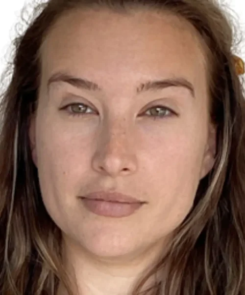 Before and after results of dermal filler treatment in Chesapeake, VA, showing reduced facial lines and enhanced volume in the lower face