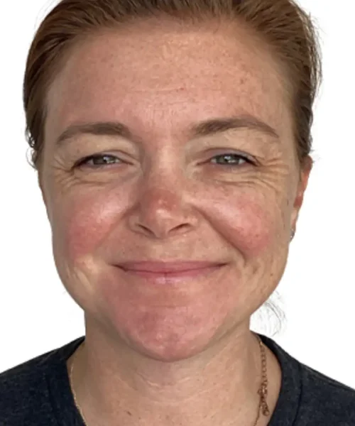 Before Photo of A Girl with facial wrinkles seeking for treatment at Eluxir MD in Chesapeake, VA