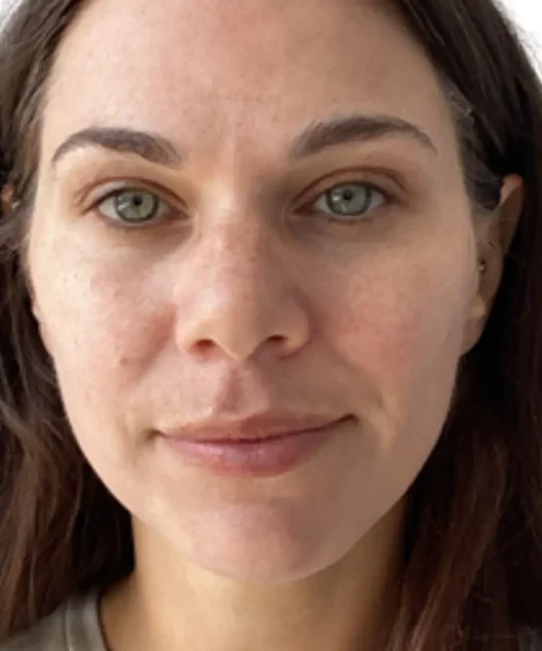 Before and after image at Eluxir MD in Chesapeake, VA, showing visible skin rejuvenation