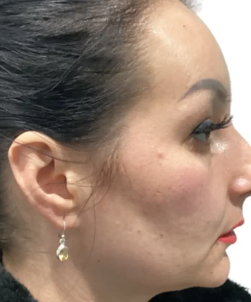 Third Before and after Treatment Image of a Women at Eluxir MD in Chesapeake, VA